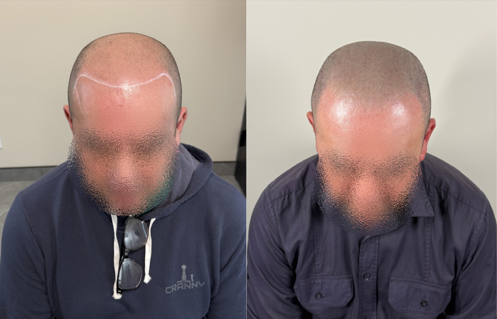 Shaved look SMP portfolio 1
